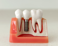 Dental Implant