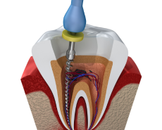 root canal treatment