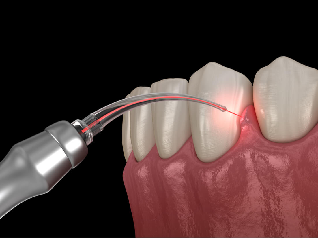 Advantages of Laser Assisted Root Canal Treatment