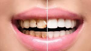 All About Full Mouth Rehabilitation