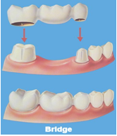 Bridge to replace a missing tooth