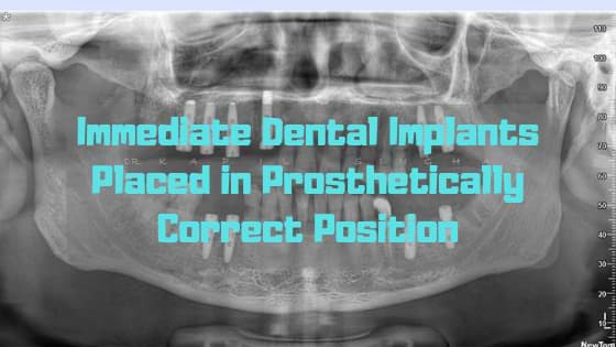 Immediate-Dental-Implants-Placed-in-Prosthetically-Correct-Position