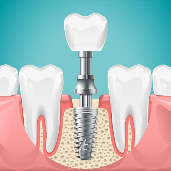 Is Dental Implants Expensive and Painful