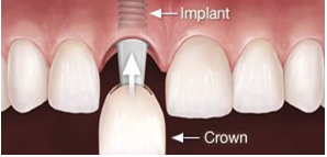 Single tooth Implant