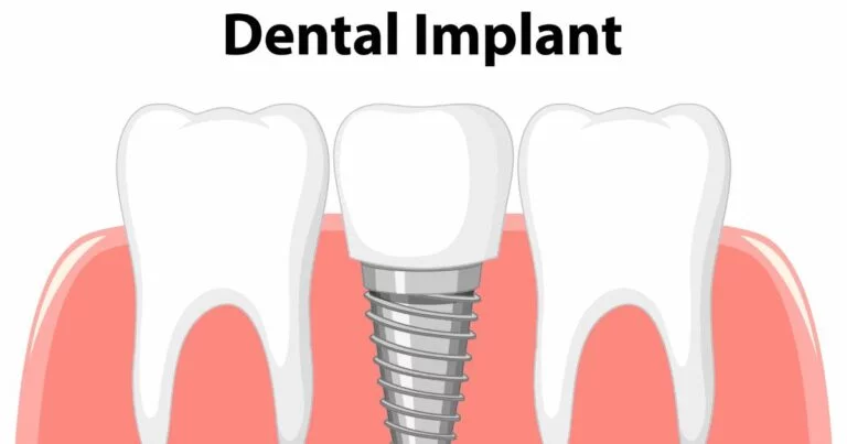 What are Dental Implants