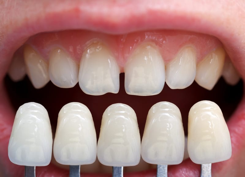 Which is the right for me Crowns or Veneers