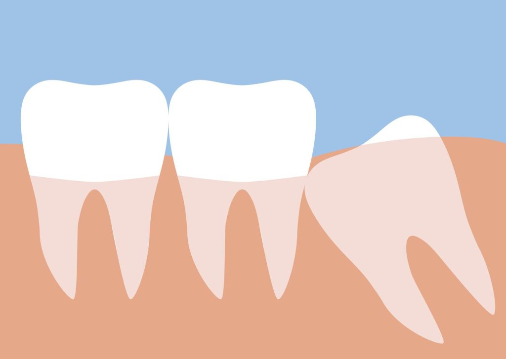 Wisdom Teeth: Why we have, Removal Age , Cause and Problems