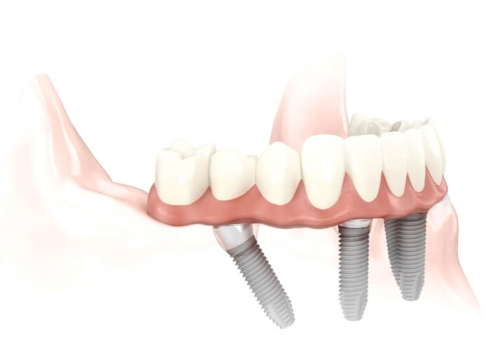 Dental Implants in 3 Days