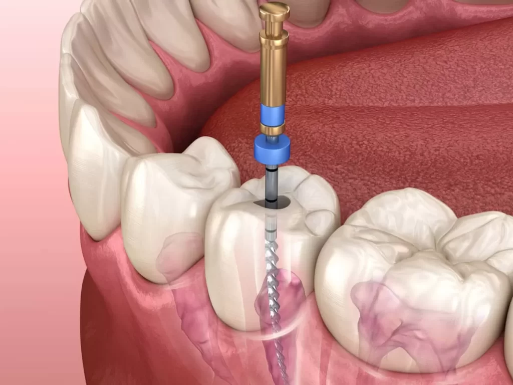 Root Canal Treatment