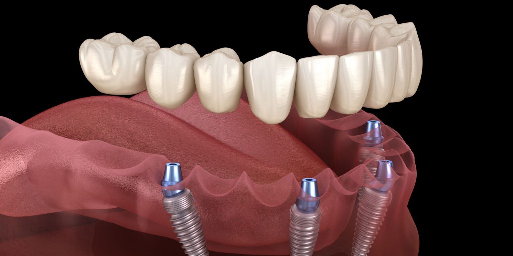 Procedure for Full Mouth Dental Implants