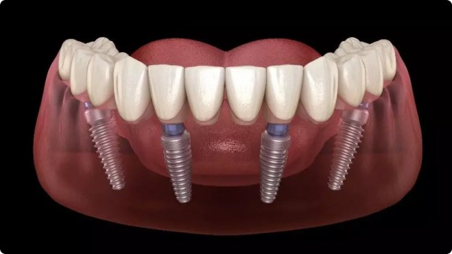 Procedure for Dental Implant