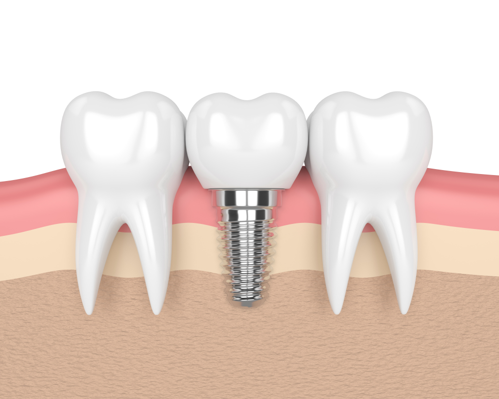 What is Single Tooth Replacement?