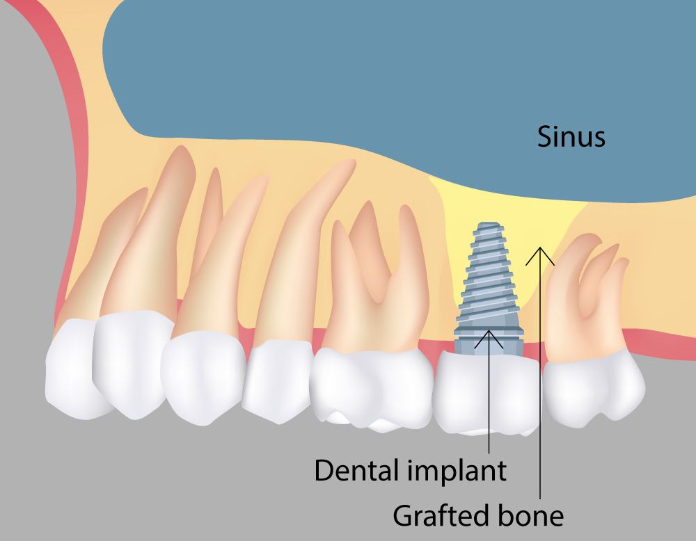 Sinus Lift Implant