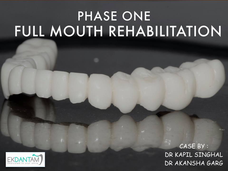 full Mouth implant Jaipur