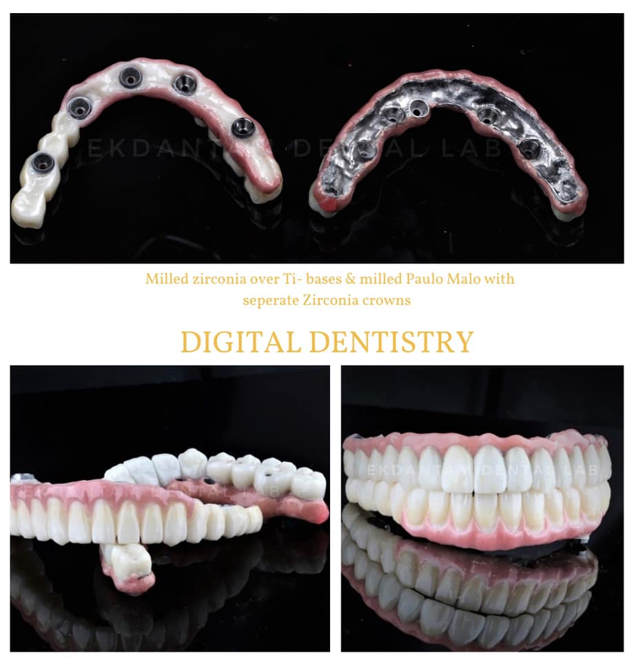 Precise Full Mouth Implants: Zirconia Mastery