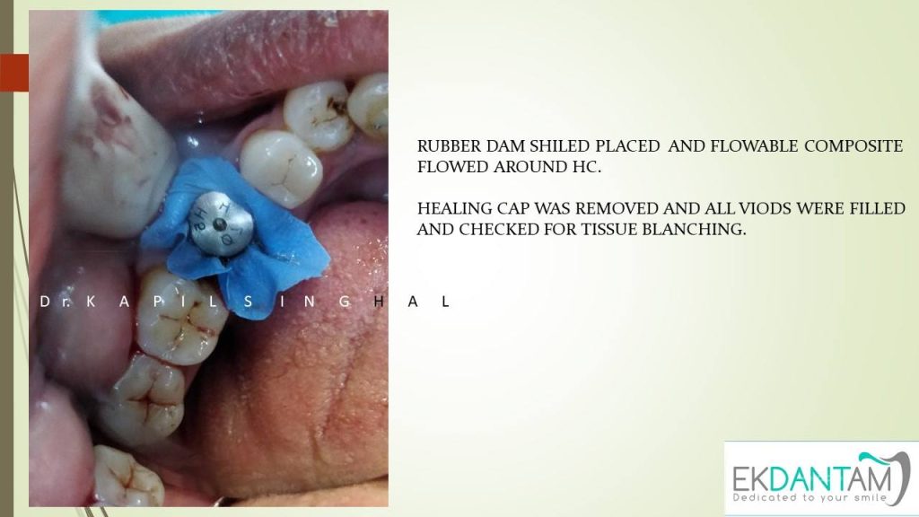 Immediate implant in lower right First Molar