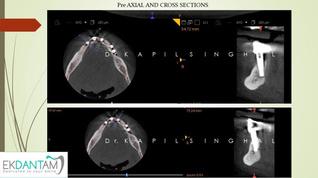 Pre AXIAL and Cross Section2