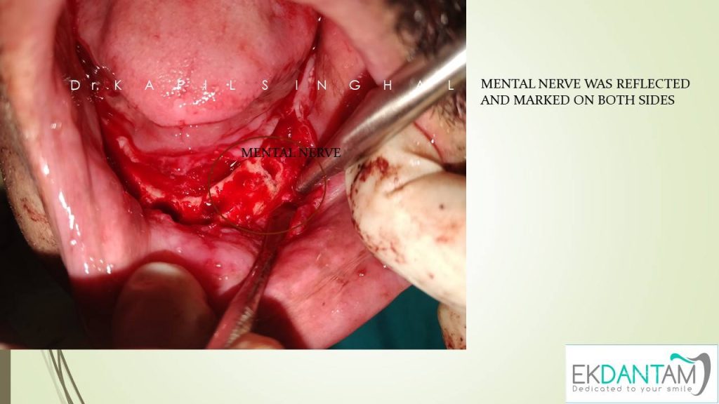 Mental Nerve was reflected and Marked on Both side