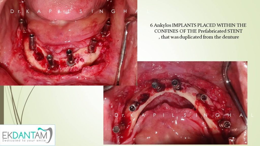 Ankylos Implants Placed within the confines of the prefabricated