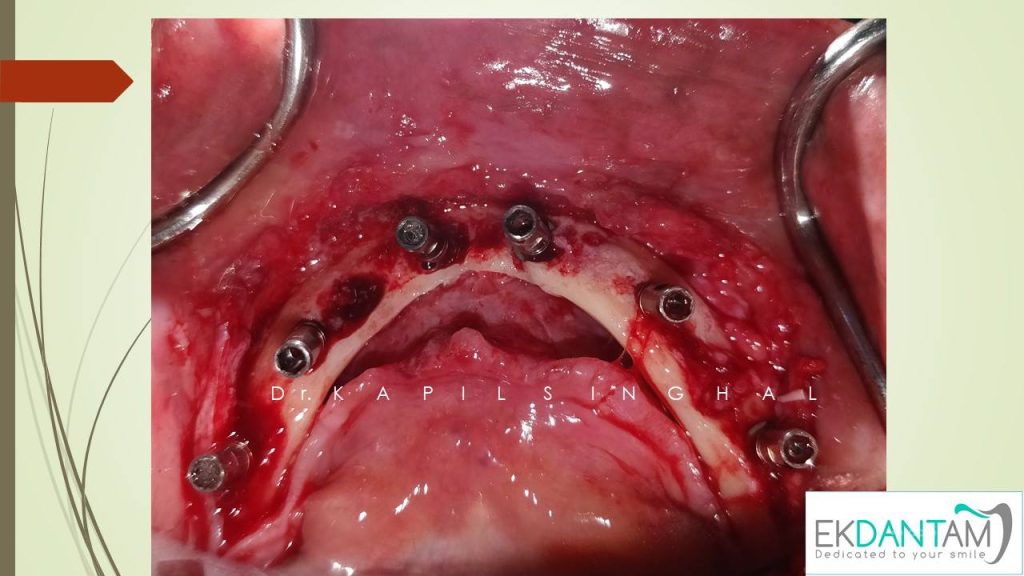 After Intraoral Welding the framework was removed and sandblasting was done.