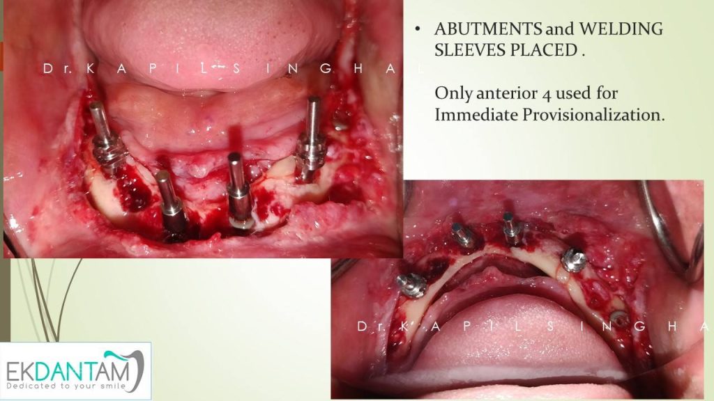 Titanium Framework after opaquer application tried in the mouth before pick up in the shell.