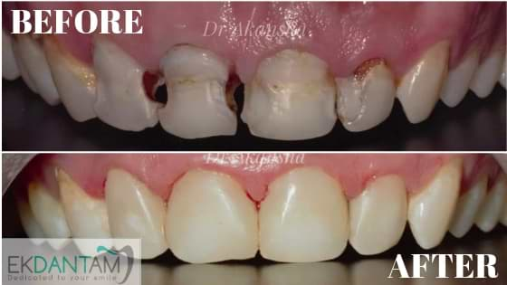 Direct Composite Restorations