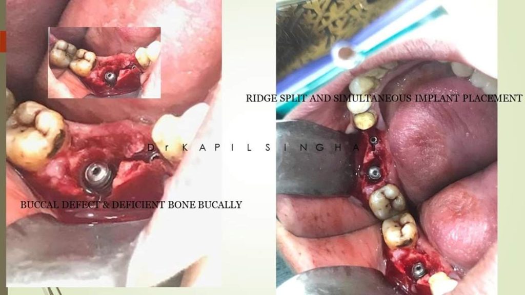 Buccal-Defect-Deficient-bone