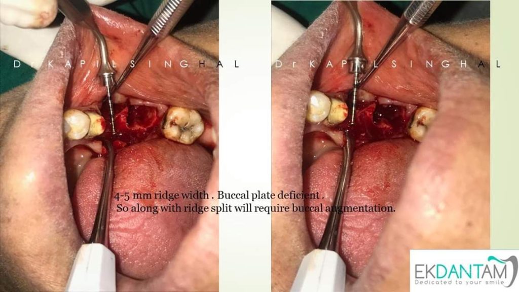 Buccal plate