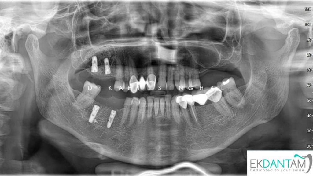 Direct-sinus-lift-and-Simultaneous-1.jpeg