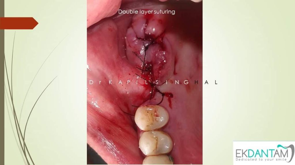 Double-layer-suturing