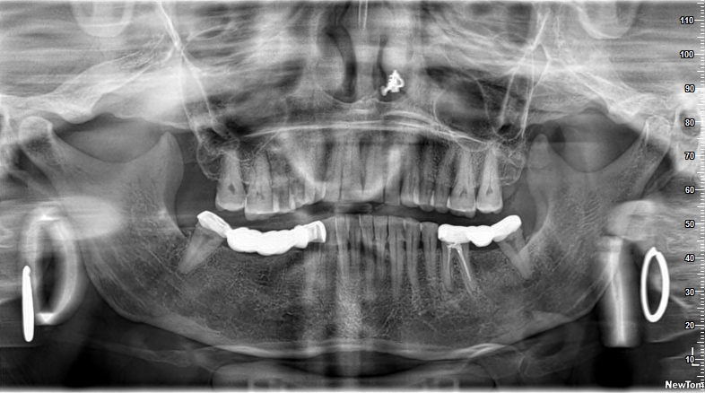 Dental Implant