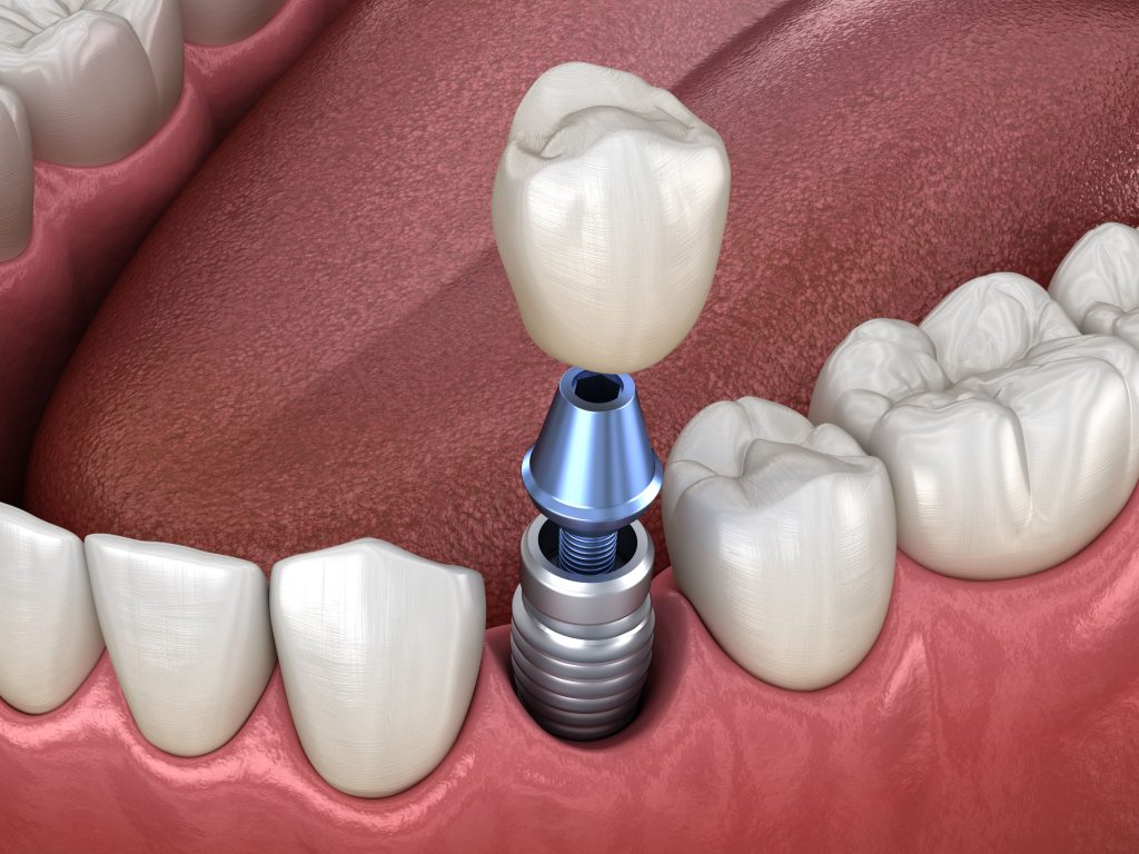 Tips for Cleaning and Maintaining Dental Implants