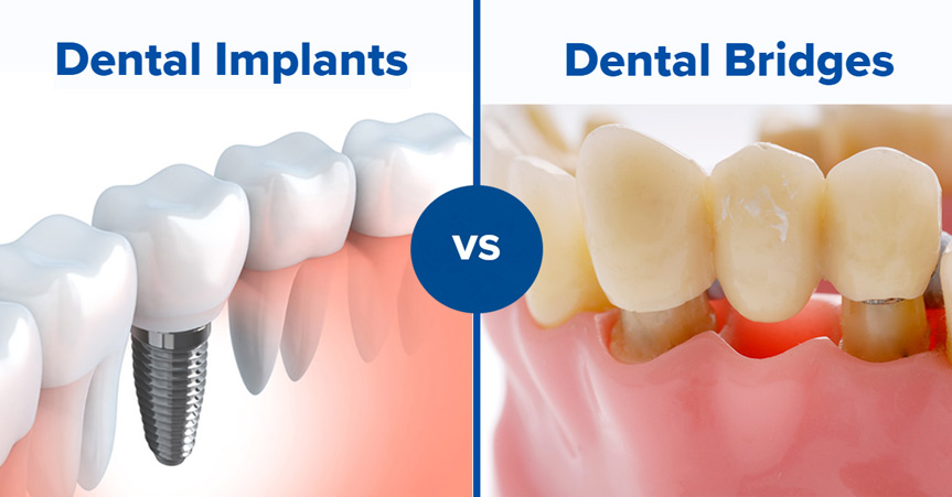 Dental Implants vs. Bridges