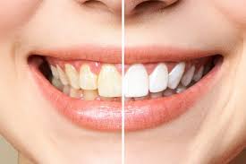 Myths About Teeth Whitening