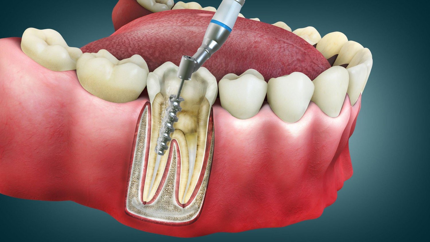 Common Myths About Root Canal Treatment