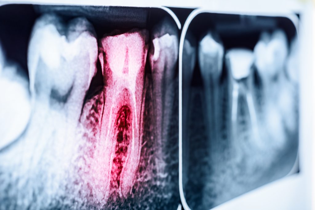 Signs You Might Need a Root Canal Treatment